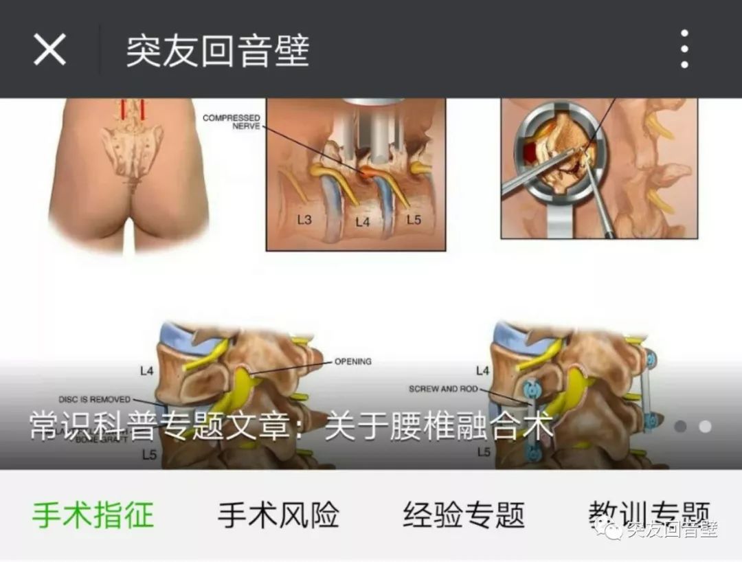 腰椎手术后两个月一直腿痛，原因、治疗与康复之路