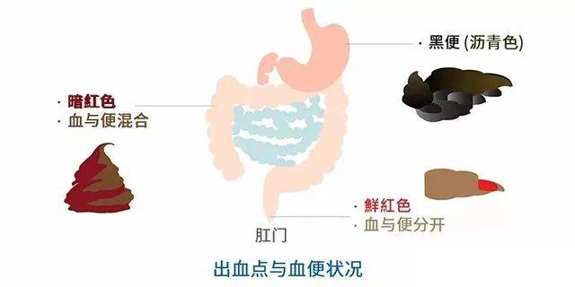 大便出血一个月，原因、影响与应对措施